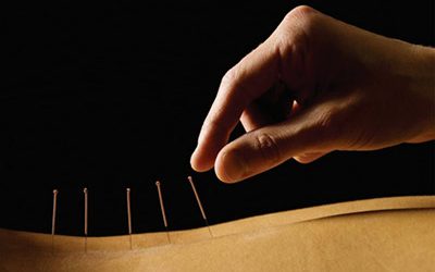 Dry Needling